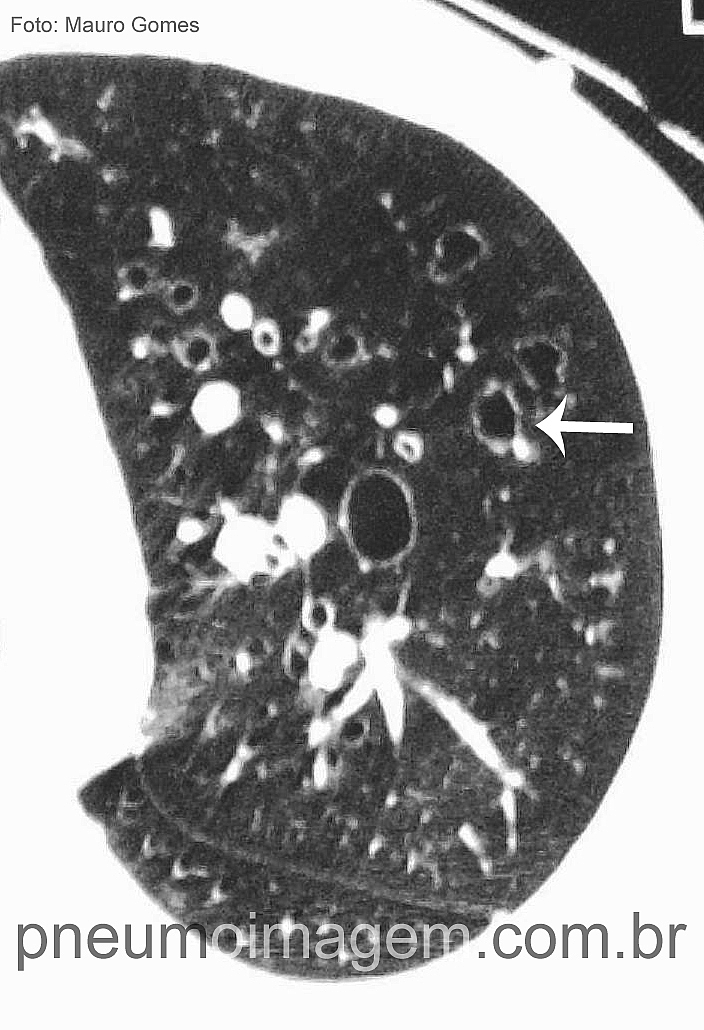 CAIXA DE FERRAMENTAS PARA BRONQUIECTASIAS: ACESSE GRATUITAMENTE